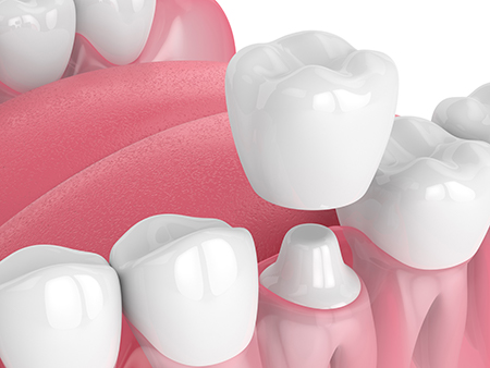 The image shows a close-up view of several artificial teeth set against a pink background with a watermark text at the bottom right corner.